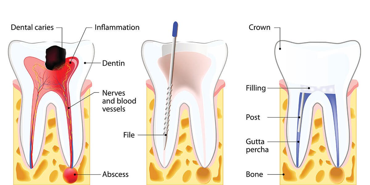 Root Canal Treatment