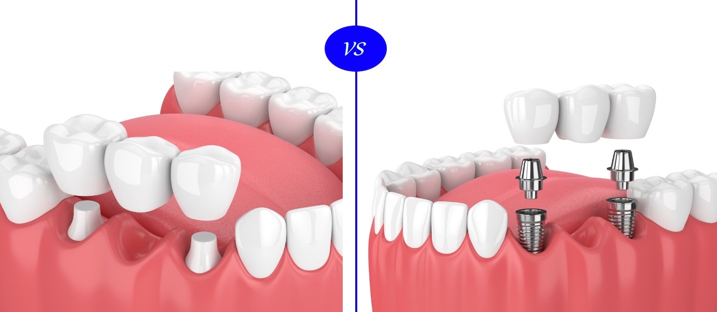 Dental Implant